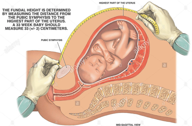 Low Dose Aspirin in the Prevention of Pre eclampsia and Fetal Growth Restriction Low Dose Aspirin in the Prevention of Pre eclampsia and Fetal Growth Restriction